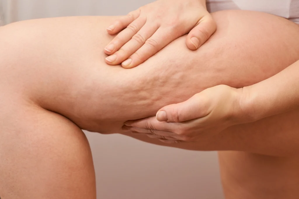 Oberschenkel, der von zwei Händen zusammengepresst wird, sodass Cellulite sichtbar wird