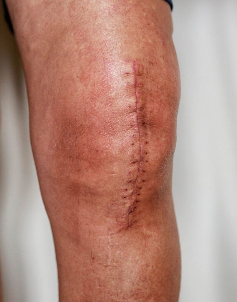 Längliche Narbe, die sich über ein Knie zieht